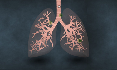 如何远离不易察觉的肺癌疾病?
