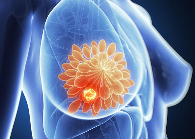 重庆中医肿瘤专家:乳房出现这几种异常,当心肿瘤或者癌变