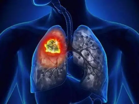 重庆肺癌老中医:怎么样才能能有效预防肺癌呢?戒烟就行了吗