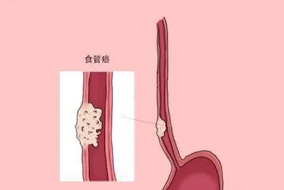 重庆中医肿瘤科医师:食管癌的这几个早期症状表现记得收藏