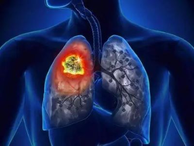 肺癌中医又是采取什么方法治疗的呢?一起了解下吧