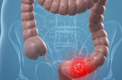 日常生活的这些肠胃信号可能在预示着你癌症的接近