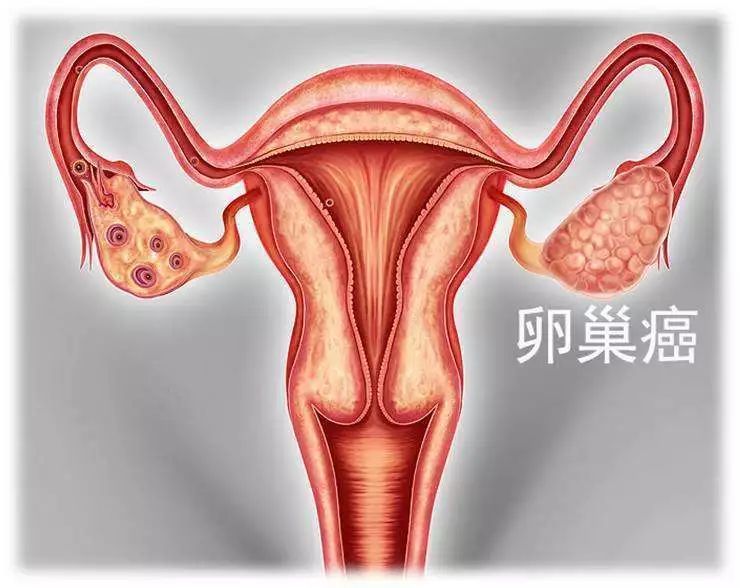 警惕！卵巢癌出现时早期会出现哪些异常表现？